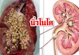 นิ่วในไตอาการ, นิ่วในไตรักษา, นิ่ว, ธนทร, รักษานิ่วในไต