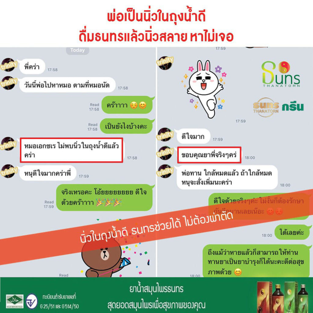 นิ่วสลาย, นิ่วในถุงน้ำดี, ธนทร, รักษานื่วในถุงน้ำดี