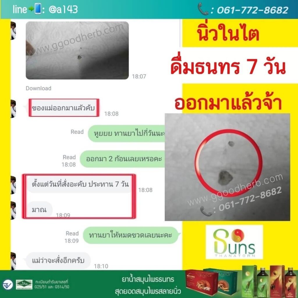 รีวิวธนทร, นิ่วในไต, รีวิวนิ่วในทางเดินปัสสาวะ